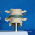 Menschliche Spinal Lumbale Medizinische Anatomie Skeleton Model (R020704)